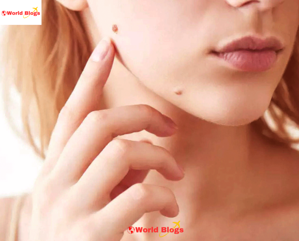 Moles and warts on the body